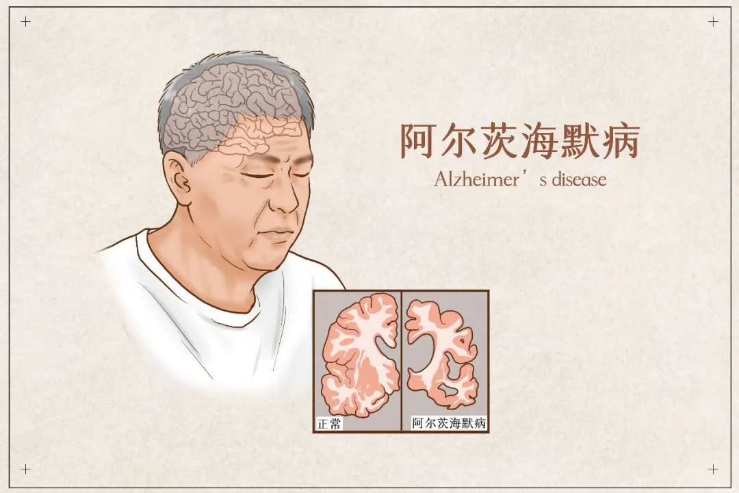 Medical illustration comparing healthy brain and Alzheimer's-affected brain — emphasizing the importance of early detection