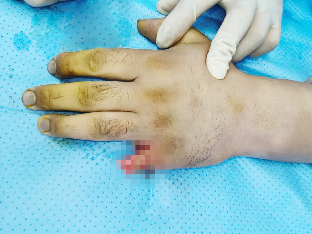 Microsurgical finger reconstruction at Beijing Edencare Hospital