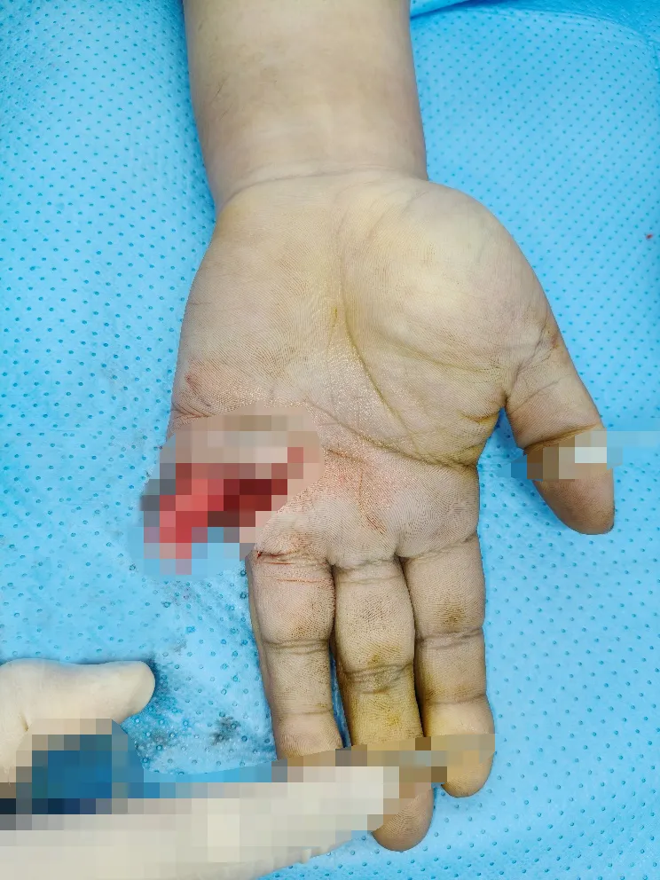 Coordinated microsurgical team reconstructing a severely injured finger