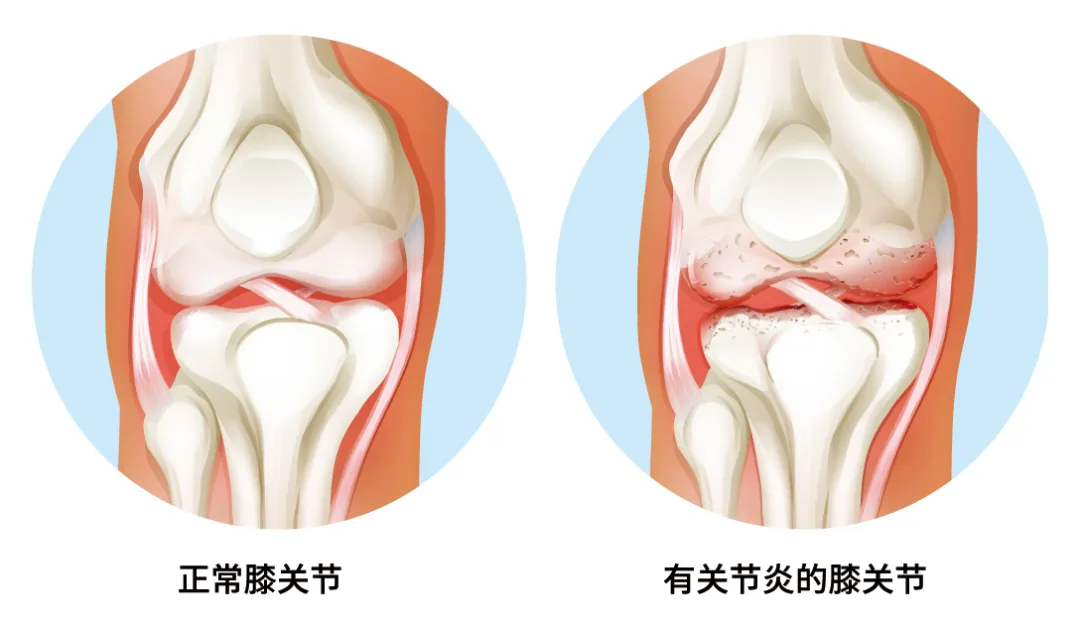 Comparison of a healthy knee joint and a knee joint with arthritis