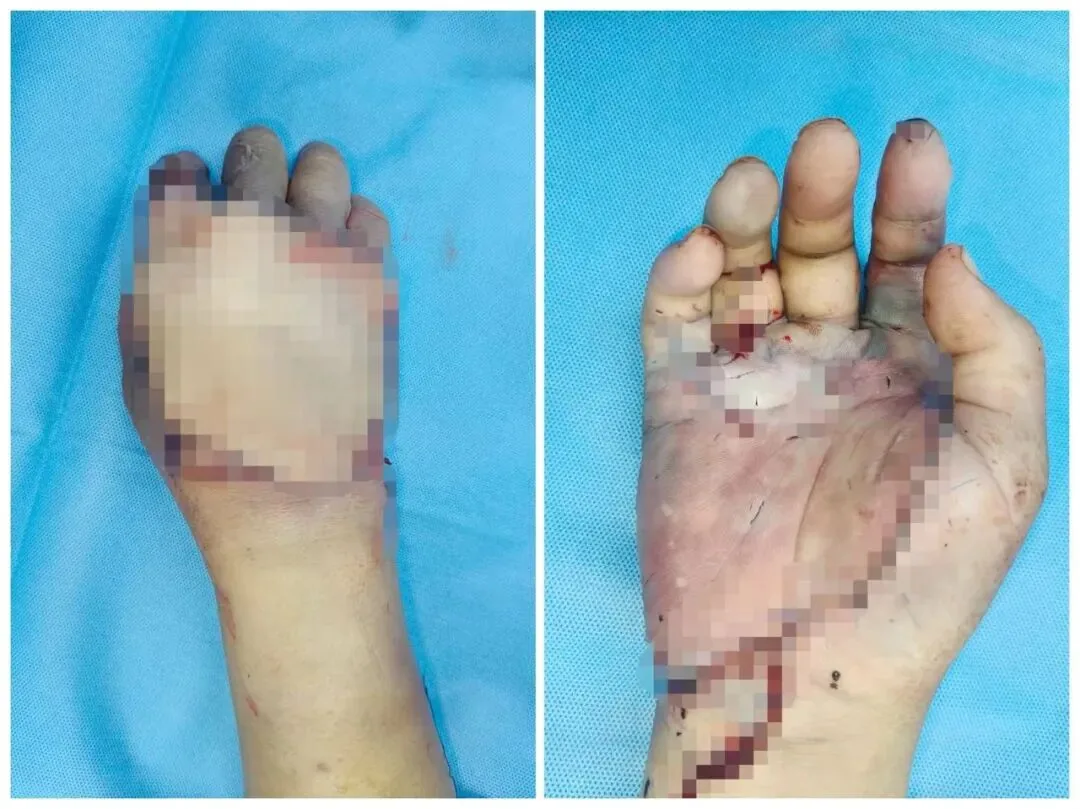 Image accompanying the section on staged treatment of severe hand injuries