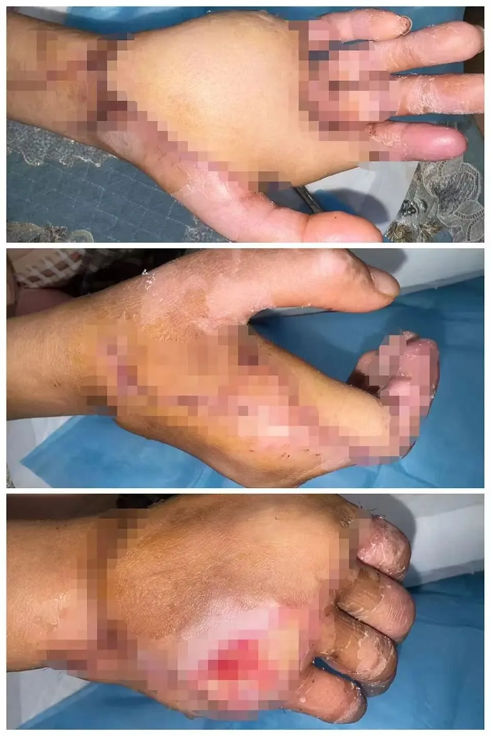 Image accompanying the section on correct on-site first aid for severe hand trauma